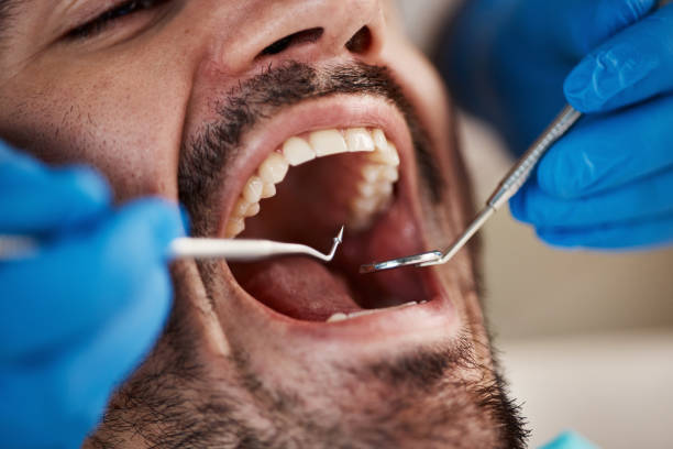 Best Urgent Care for Lost Fillings or Crowns in Riverdale Park, CA